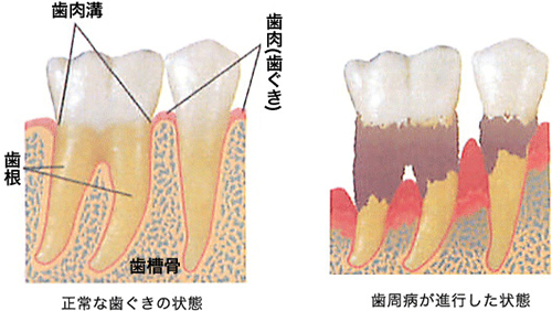 歯周病