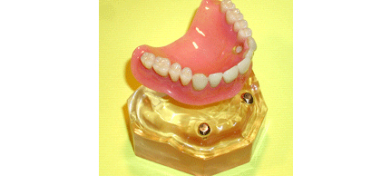 磁石を使った義歯