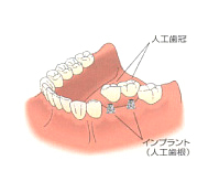 インプラント